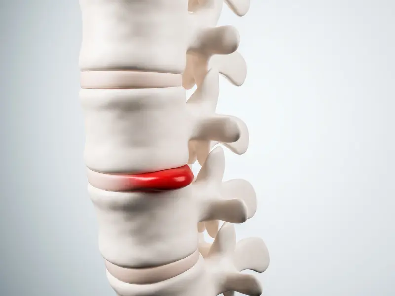 Disc Injury Treatment Near Me in Aurora, CO. Chiropractor For Disc Injury Pain Relief.