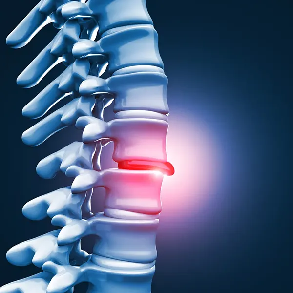 Disc Injury Treatment Near Me in Aurora, CO. Chiropractor For Disc Injury Pain Relief.